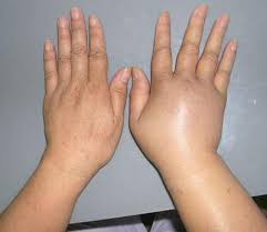 Phù bạch mạch - Hình ảnh minh họa